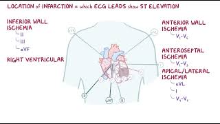 Clinical Reasoning  Coronary Artery Disease  Osmosis [upl. by Salakcin321]