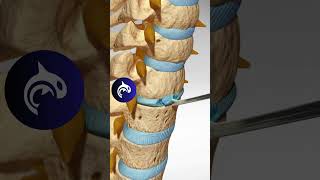 See how an Artificial Cervical Disc Replacement of the Spine works in 3D animation [upl. by Atirahc91]