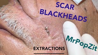 Giant blackheads imbedded in scar tissue extracted Common occurrence with surgical procedures [upl. by Aerdnua]