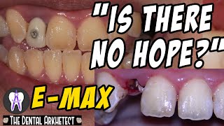 Restoring A Heavily Fractured Tooth With A Post and EMax Crown C18 4K [upl. by Ymas]