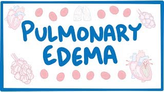 Pulmonary Edema  causes symptoms diagnosis treatment pathology [upl. by Firooc72]