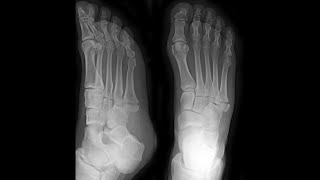 5th Metatarsal Base Fracture Foot [upl. by Thacher601]