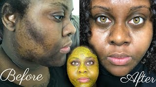 5 DAY TURMERIC FACE MASK CLEARED MY HYPERPIGMENTATION IM SHOOK [upl. by Allekram720]