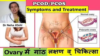 All about PCOD  PCOS  pcos Ayurvedic Treatment In HINDI  nehajoshi [upl. by Imhskal]