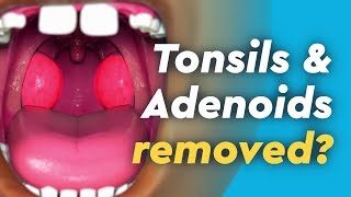 Tonsils and Adenoids Surgery [upl. by Inaluahek]