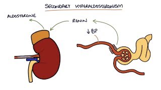 Hyperaldosteronism and Conns Syndrome [upl. by Blockus]