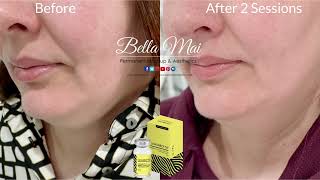 Lemon Bottle Fat Dissolver  CHIN  Before amp After 2 Treatments [upl. by Persons]