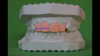 Orthodontic model analysis in Permanent Dentition [upl. by Rickey]