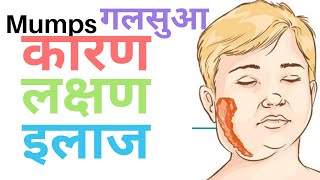 MUMPS  गलसुआ  गलसुआ की दवाई  mumps का इलाज  गलसुआ के लक्षण  क्या हे गलसुआ  Mumps treatment [upl. by Irby635]