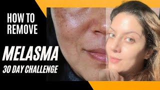 Melasma Removal at Home I Melasma Remove cream I Melasma Skin Care Regimen Routine [upl. by Nwahsauq]