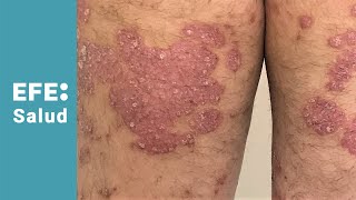 Freno a la psoriasis con innovación científica [upl. by Rehpotsrhc]