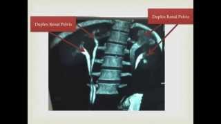 Congenital Anomaly Ureter Duplex and Duplex Renal Pelvis [upl. by Renato]