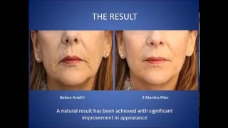 Artefill or Bellafill Facial Filler Before and After [upl. by Hetti725]