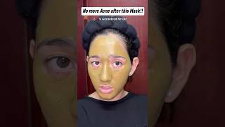 No More Acne After This Mask youtubefeed glow acne acnetreatment shorts trending foryou [upl. by Grantland]