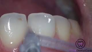 The power of Aquacare Dental Air Polishing [upl. by Dougy]