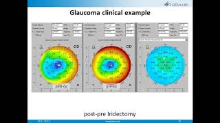 Online Seminar OCULUS Pentacam® live at AAO 2013 New Orleans [upl. by Tabbatha]