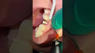 DentaLaze used for Gingivectomy Around an Implant [upl. by Angele]