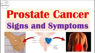 Prostate Cancer Signs and Symptoms Urinary Sexual amp Metastatic Symptoms [upl. by Danie]