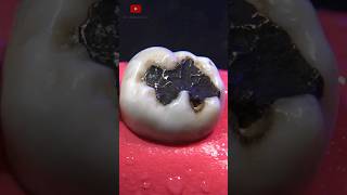 Restauración dental satisfying [upl. by Olivie711]