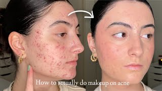 How to Make Makeup Look Smooth amp Natural on Acne and Textured Skin [upl. by Vento]