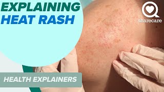 Explaining Heat Rash And How To Treat It  Health Explainers  Sharecare [upl. by Keverne394]