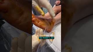 GANGLION CYST REMOVED IN UNDER 2 MINUTES 😱 [upl. by Jennilee539]