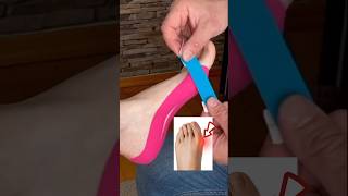 Kinesio taping offers a supportive aid in alleviating bunion pain providing relief [upl. by Eizzo270]