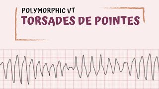 Torsades de Pointes [upl. by Neelie]