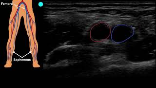 POCUS Venous Access  Part 1 [upl. by Moynahan331]