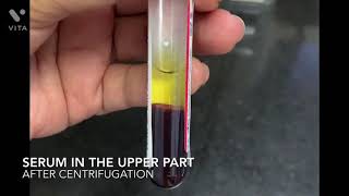 How is serum extracted from the blood sample [upl. by Amary]