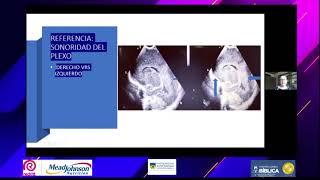 Leucomalacia Periventricular [upl. by Ahser]