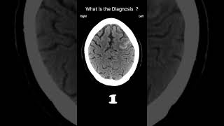 Subarachnoid haemorrhage Sulcal bloodAcute CT Brain Extraaxial haemorrhage68radiologychannel007 [upl. by Lesiram136]