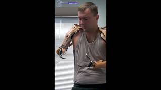 Upper Extremity Body Powered Prosthetics  Prosthetic Innovations [upl. by Larrej]