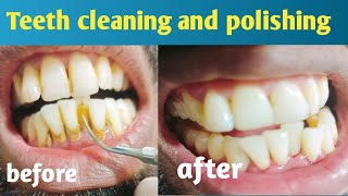 teeth cleaning and polishing [upl. by Panaggio]