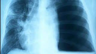 X Ray chest of a case of HYDROPNEUMOTHORAX by DR VISHWA MEDICAL COACHING WHATSAPP 9930788955 [upl. by Gala230]