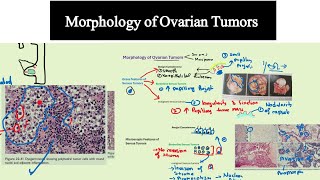 Morphology of Ovarian Tumors Special Pathology DrMUsman [upl. by Zebaj664]