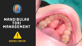 Mandibular Tori Management [upl. by Nasah]