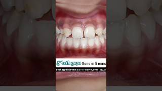 Teeth Gaps gone in just 5 minutes No braces Dr Srishti Bhatia smilemakeover dentist [upl. by Esirahc]