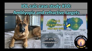 CataractCoach 1658 IOL calc case study 10 amblyopia and refractive targets [upl. by Llireva]