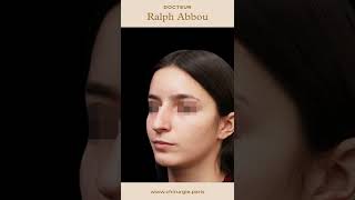 Résultat après rhinoplastie ultrasonique à Paris  Dr Abbou [upl. by Daas]