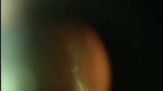 Eye Floaters Scott Geller MD Fort Myers Florida [upl. by Ambler]