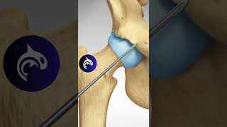 See how a Pincer Impingement of the Hip is repaired  3D Animation [upl. by Aneez]