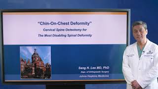 Cervical Spine Osteotomy for ChinonChest Deformity [upl. by Anuaf420]