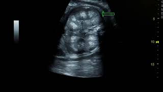 large echogenic fetal kidneys [upl. by Alul]