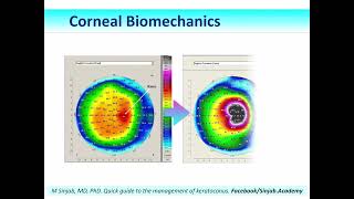 Quick Guide to the Management of Keratoconus Part 1 [upl. by Shimberg]