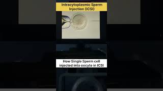 Intracytoplasmic Sperm Injection ICSI in IVF ivf icsi ivfsuccess ivfjourney ivfcenter [upl. by Eikcaj575]