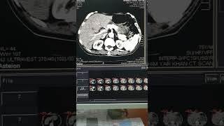 CT Liver Cystic Hepatic Masses Leading to Org Hydatid Cyst [upl. by Yelsnit]