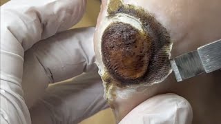 Pedicure video44，vertical plantaris，plantar wart，feet [upl. by Ettenel]