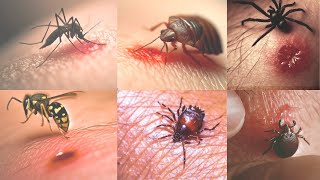 7 Picaduras más comunes de insectos Cómo identificarlas y qué hacer al respecto [upl. by Ahsiemat920]