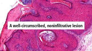 Pathology of Pilar Sheath Acanthoma by Dr Sampurna Roy MD [upl. by Joanie]